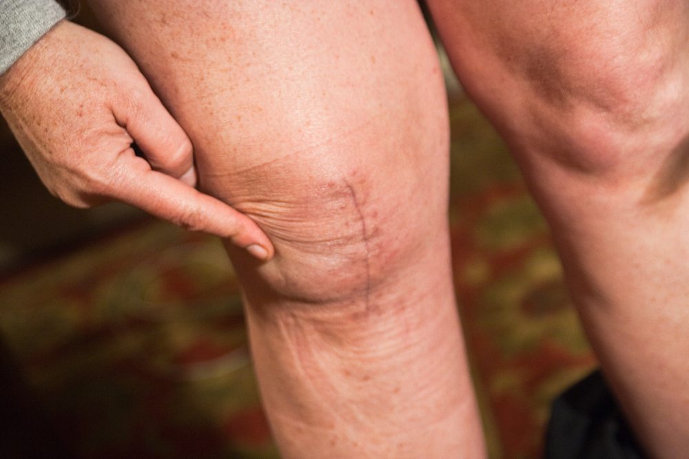 Почему болит колено после замены тазобедренного сустава