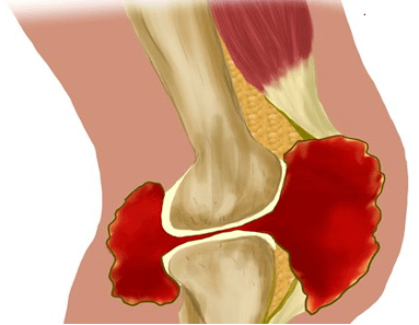 Изображение - Народные средства от боли в коленных суставах %D1%81%D0%B8%D0%BD%D0%BE%D0%B2%D0%B8%D1%82