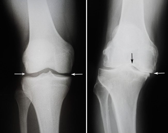 Гонартроз коленных суставов 2 степени лечение по бубновскому