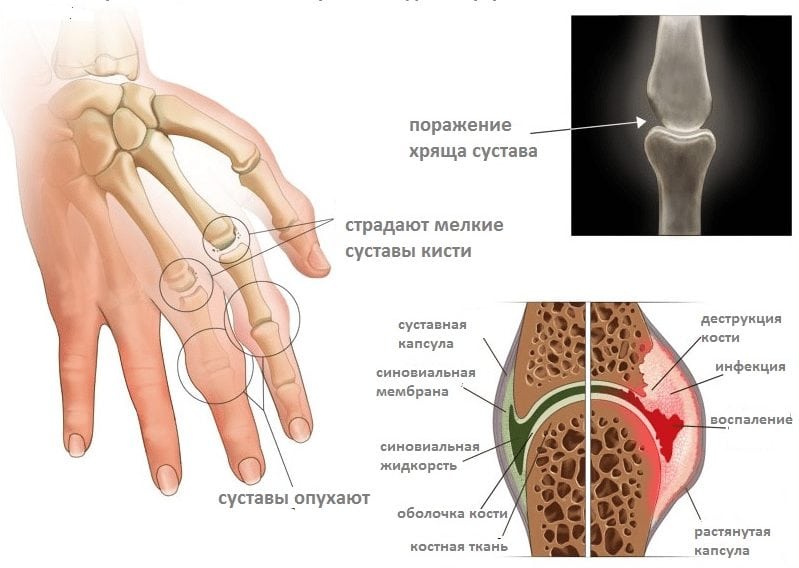 Артрит - лечение народными средствами: как лечить коленный сустав народными методами, рекативный, ревматоидный и псориатический артрит рук