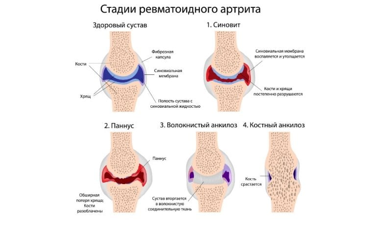 Ревматоидный артрит народные средства компресс thumbnail
