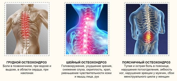 Шейный остеохондроз лечебная гимнастика в картинках