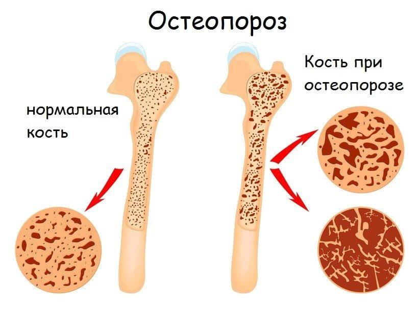 Лечение народными средствами остеопороз коленного сустава