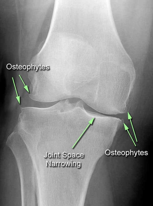Последствия ревматоидного артрита коленного сустава