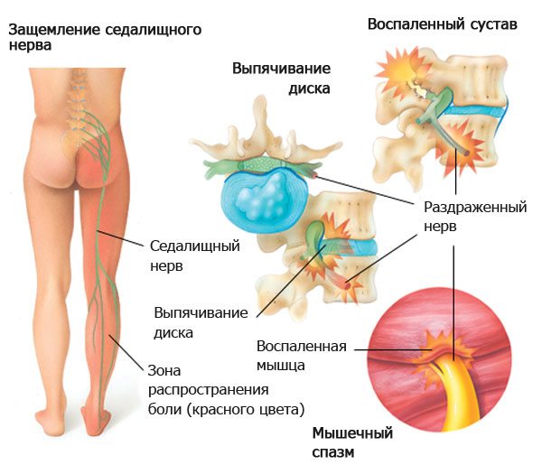 Сколько будет болеть спина после прострела