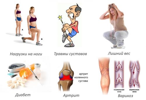 Изображение - Упражнения для восстановления коленного сустава Prichiny-artroza-500x344