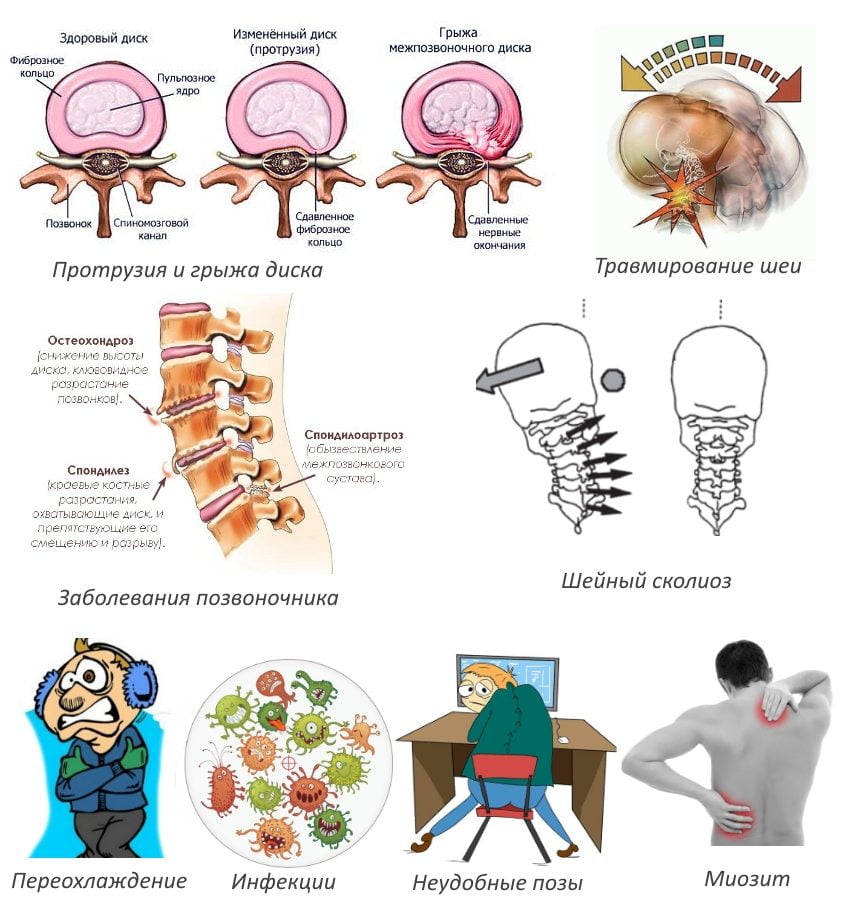 Где болит при радикулите фото