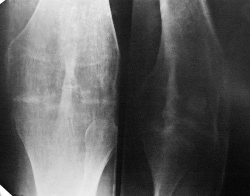 Остеоартроз суставов и его лечение
