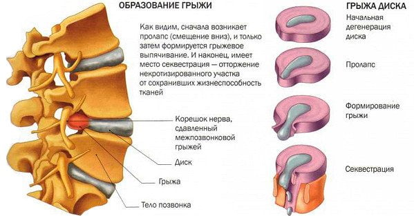 Повышение температуры при остеохондрозе поясничного отдела