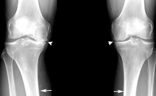 Остеофиты коленного сустава лечение