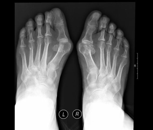 Отек при артрите пальцев ног