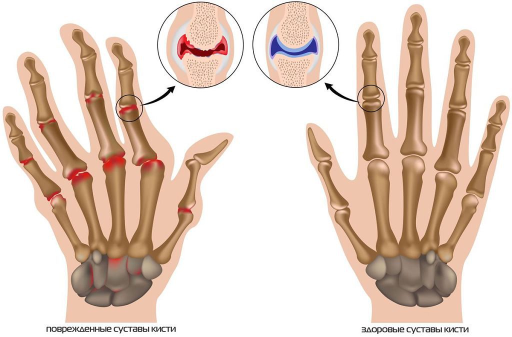 Лечение остеоартроз суставов пальцев рук лечение
