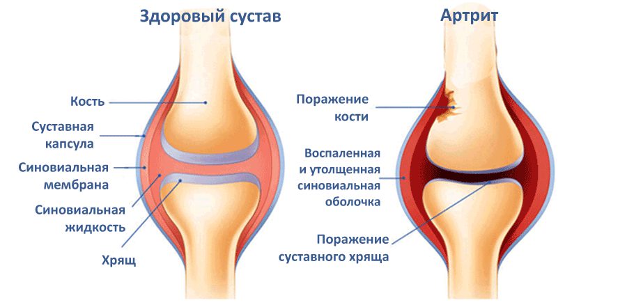 Все в порядке а суставы болят