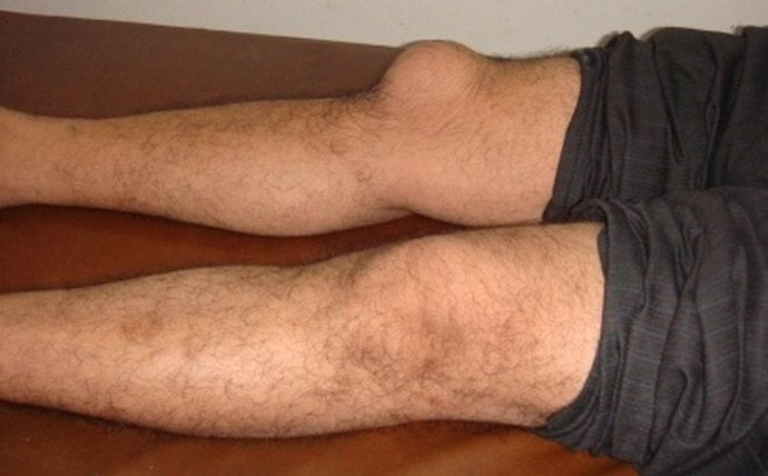 Лечение болезни суставов ног колени лечение