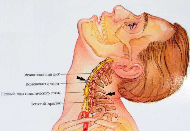 Как вылечить стеноз спинномозгового канала