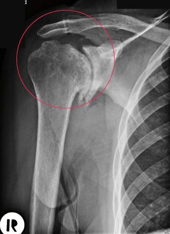 Изображение - Боли и хруст в плечевом суставе лечение mozhet-li-povisitsya-temperatura-pri-vospalenii-sustavov-1