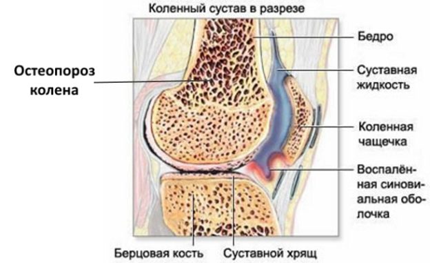 Лечение остеопороза народными средствами колен