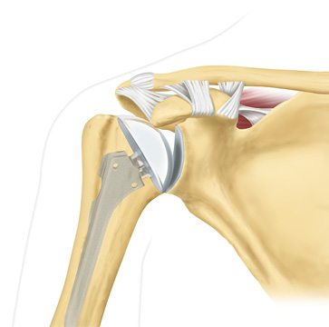 Остеоартроз плечевого сустава второй степени