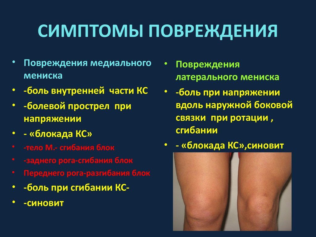 Травмы коленного растяжение мениска