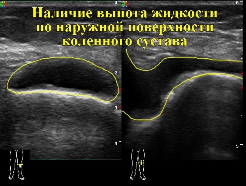 Лечение ревматоидного полиартрита коленных суставов thumbnail
