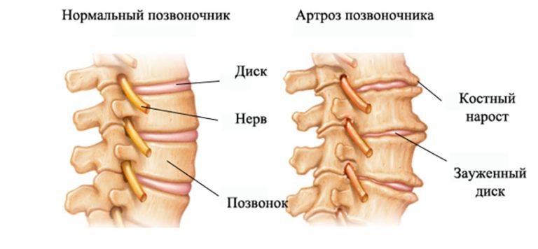 Что такое остеоартроз шейного отдела позвоночника