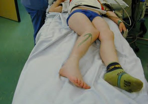 Варусная деформация ног у ребенка лечение