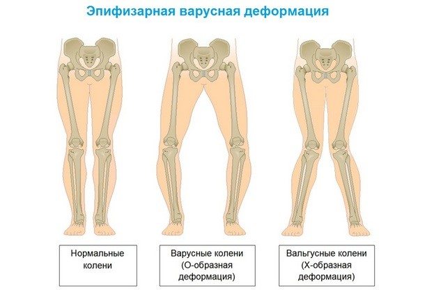 Варусная деформация ног у ребенка лечение thumbnail