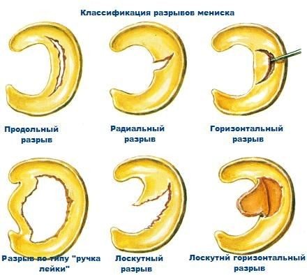 Изображение - Дегенеративное изменение левого сустава klassifikatsiya-razryvov-meniska