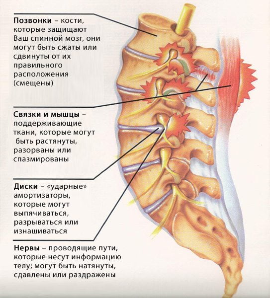 Как лечить хандроз поясницы