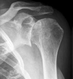 Изображение - Начальный артроз плечевого сустава rentgen_artroza