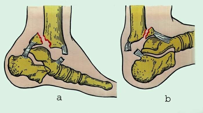 Болят голеностопы на обеих ногах лечение народными средствами в домашних условиях
