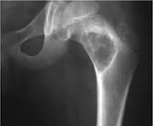 На рентгенограмме тазобедренного сустава определяется