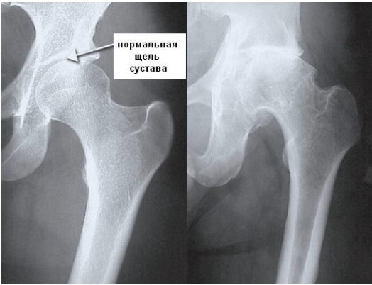 Тазобедренный сустав артроз лечение народным средством