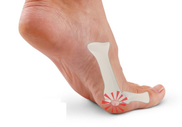 Лечение артроза сустава большого пальца стопы
