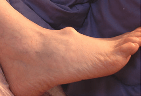 От чего болят стопы ног лечение