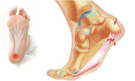 Болит мышца на ноге в области стопы thumbnail