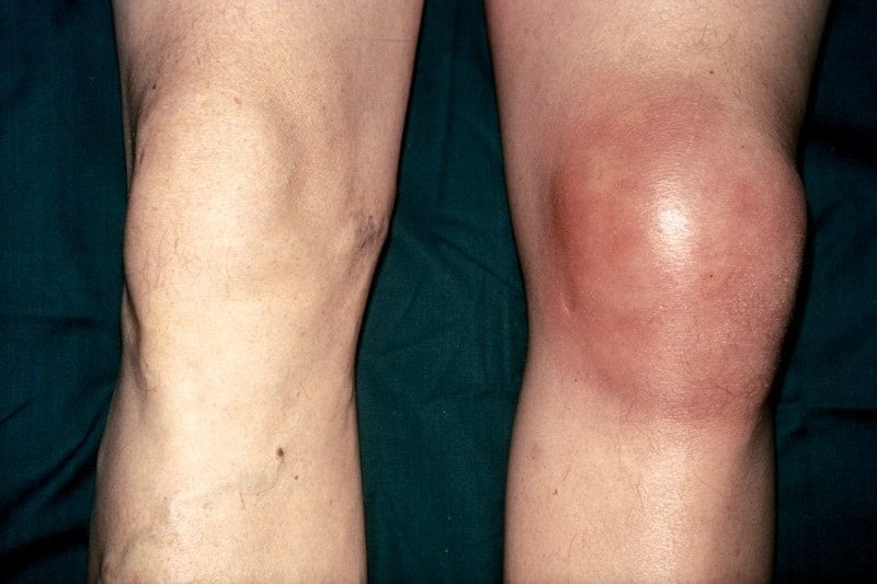 Артрит коленного сустава симптомы и лечение фото у взрослых