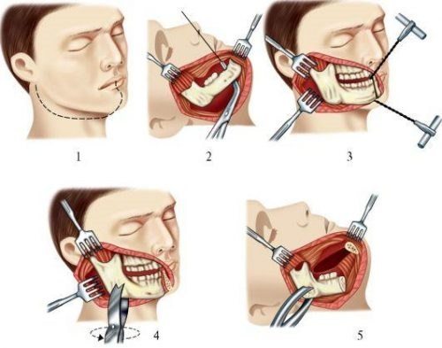 Методы лечения артроза челюстного сустава
