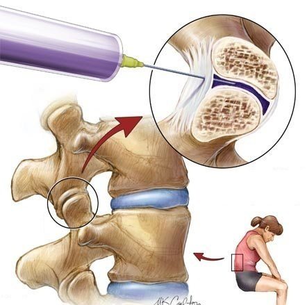 Виды уколов в позвоночнике