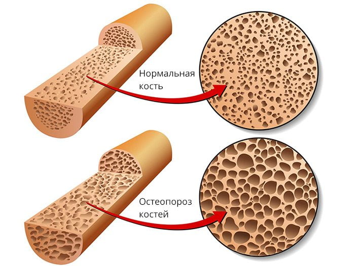 Терипаратида — применение при остеопорозе