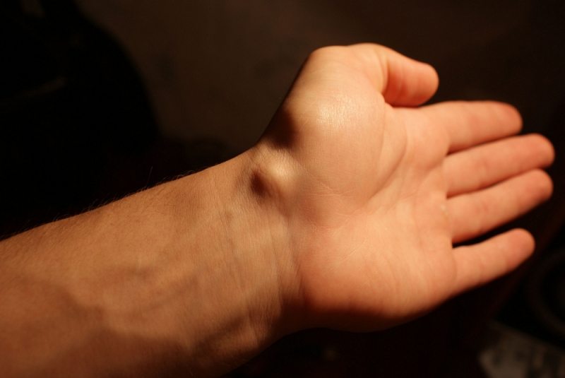 Шишки на суставах пальцев рук причины симптомы и лечение
