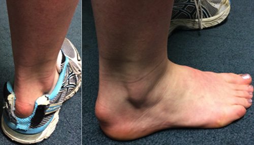 Болит мышца на ноге в области стопы