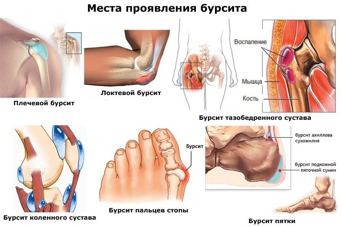 Воспаление суставов ног причины лечение
