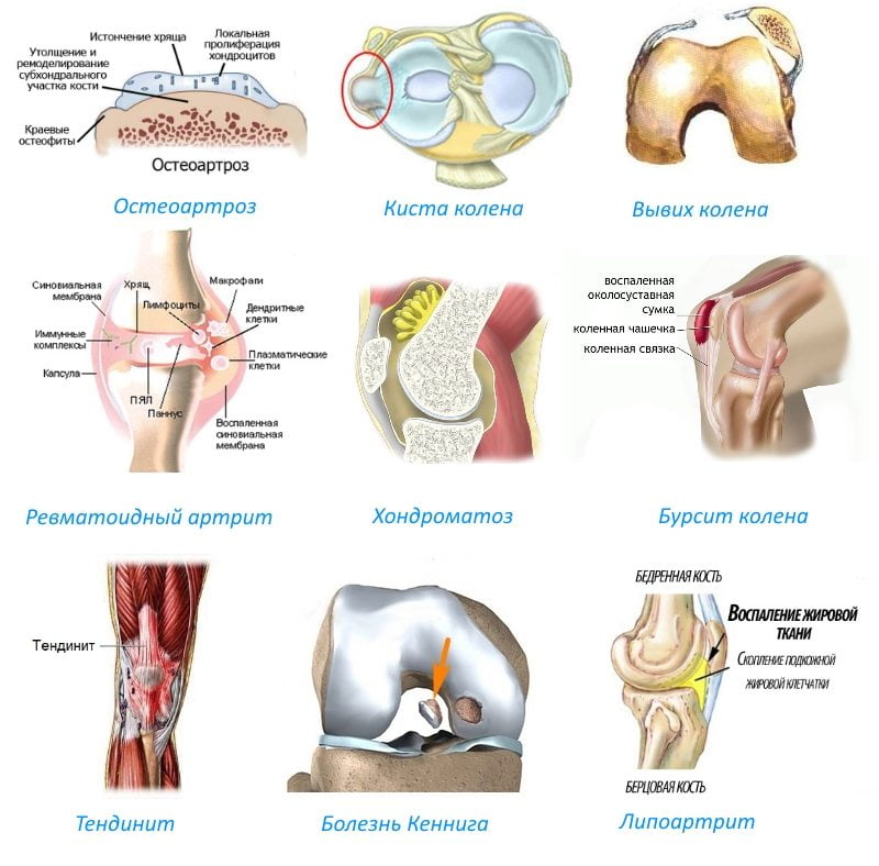 Изображение - Боль в коленном суставе инъекции prichiny-vospaleniya-kolennogo-sustava-1