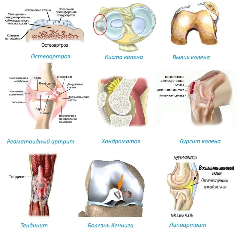 Изображение - Уколы для суставов prichiny-vospaleniya-kolennogo-sustava-1