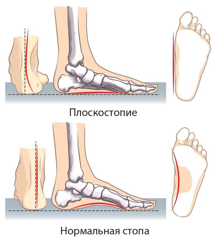 Болит мышца на ноге в области стопы