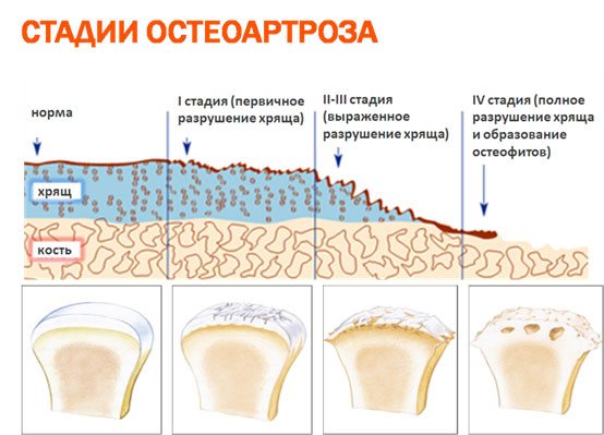 Первичный остеоартроз лечение