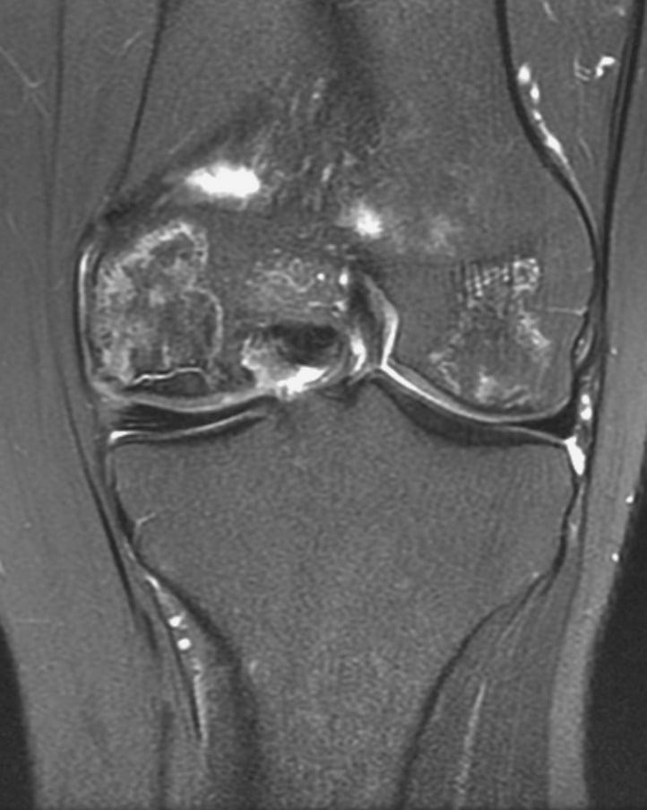 Лечение остеонекроза коленного сустава