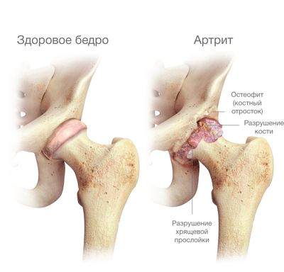 Лечение ревматоидного артрита тазобедренного сустава народными средствами