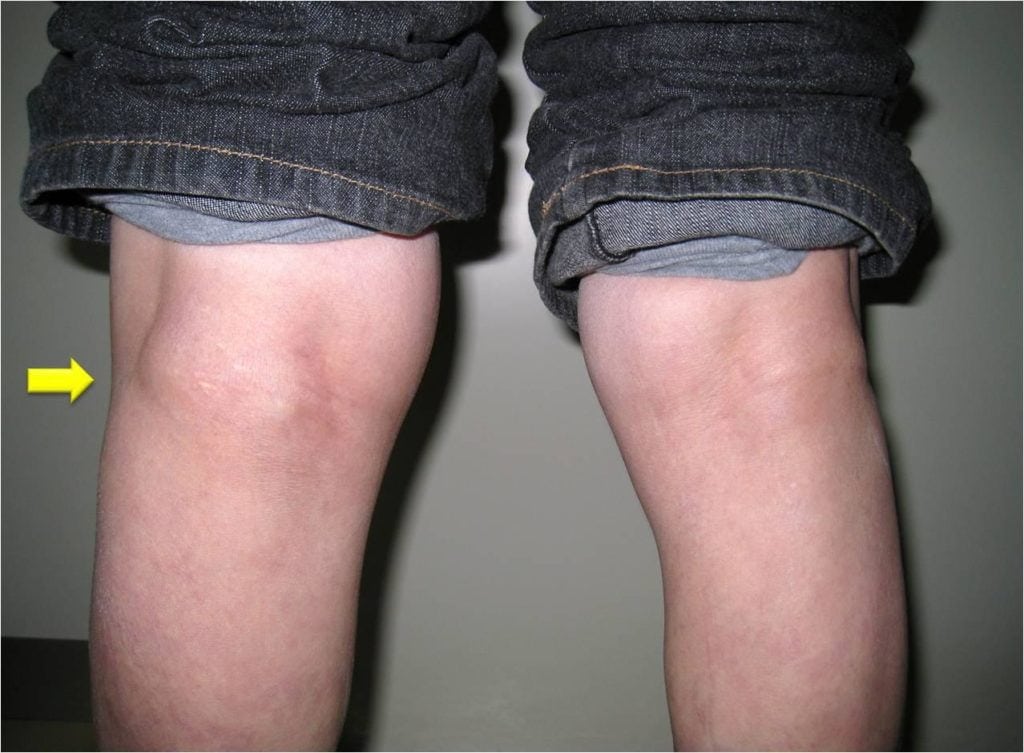 Как вылечить гигрому коленного сустава